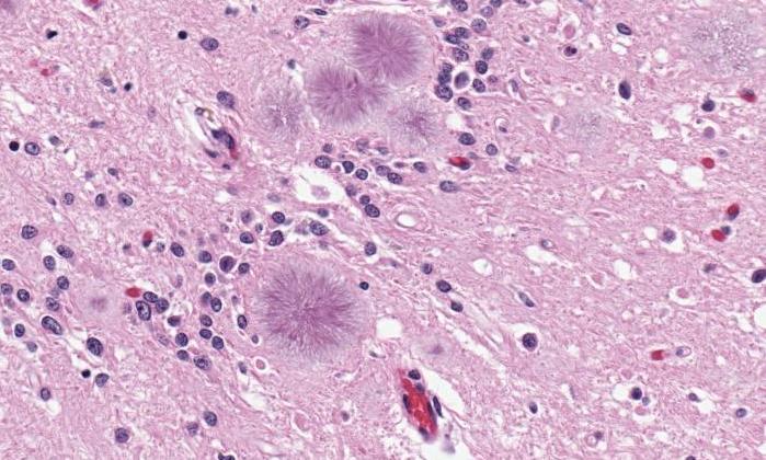 Amyloid plaques in a brain tissue sample